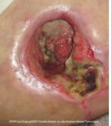 decubitus wond stuitje